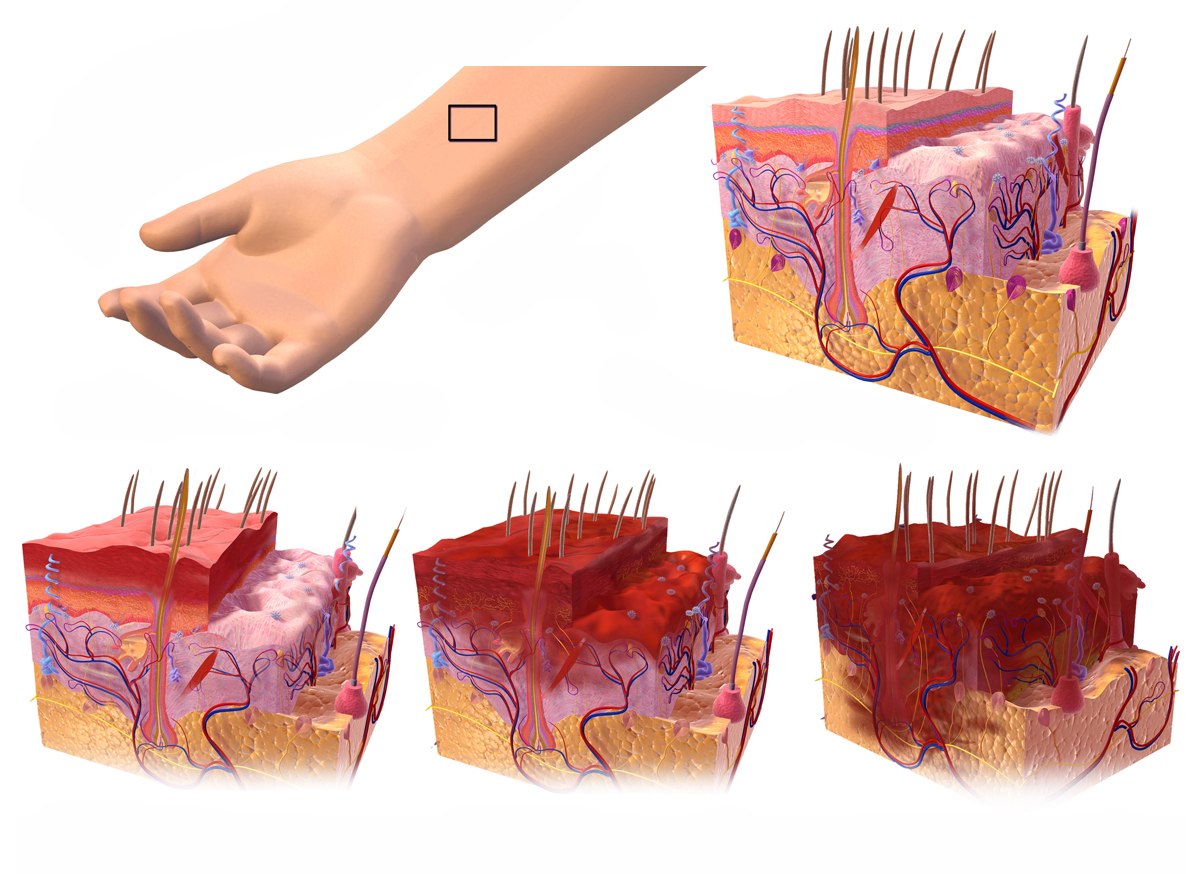 Blausen Medical illustration: blocks of skin showing normal skin and first, second and third degree burn damage deepening through the layers