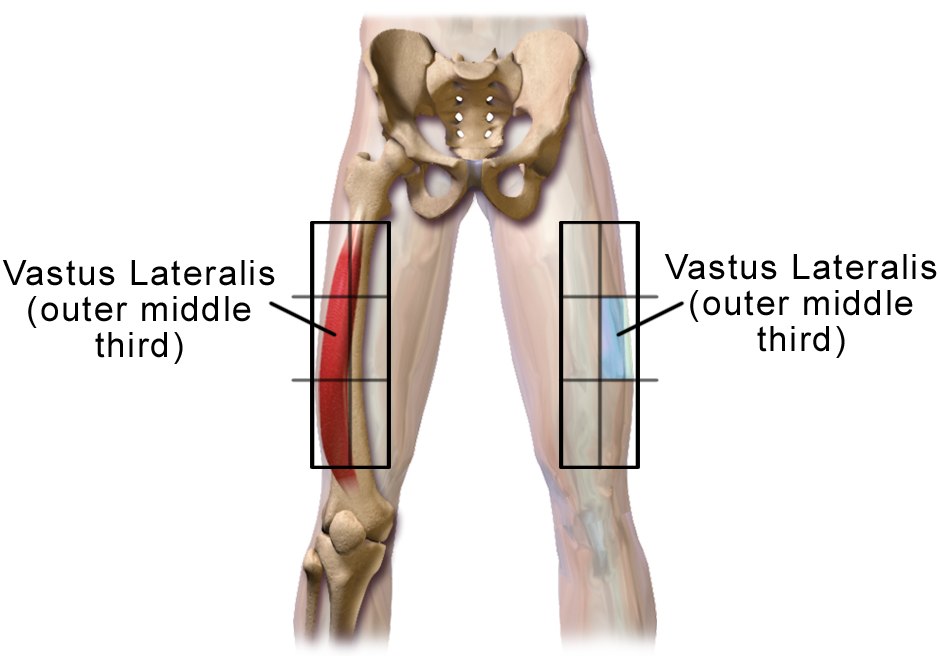 Blausen illustration of the thigh showing the vastus lateralis outer middle third injection zone on both legs