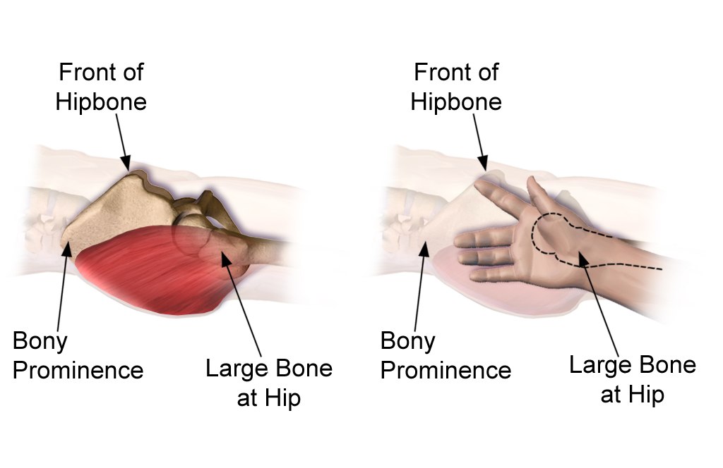 Blausen illustration of ventrogluteal landmarking: palm on the greater trochanter, fingers spread toward the front of the hipbone