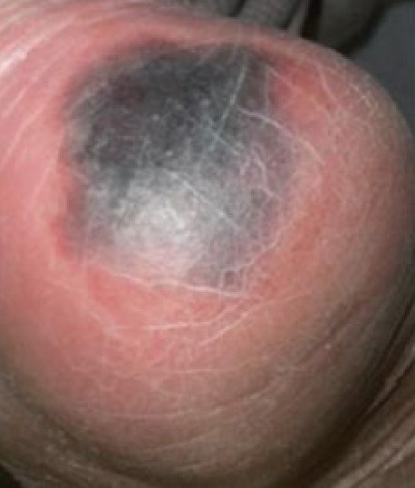 Deep tissue pressure injury: heel with deep purple-maroon discoloration