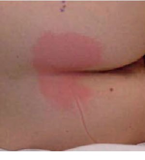 Stage 1 pressure injury: intact skin with non-blanchable redness over the sacrum