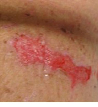 Stage 2 pressure injury: shallow open wound with a pink-red bed