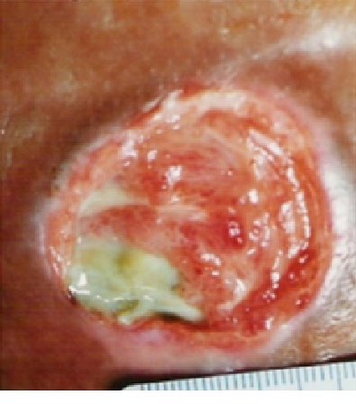 Stage 3 pressure injury: deep crater with yellow slough, fat visible