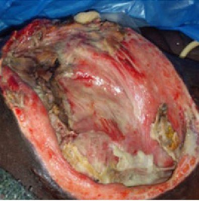 Stage 4 pressure injury: large deep wound with exposed underlying structures