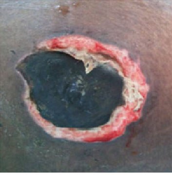 Unstageable pressure injury: wound bed completely covered by black eschar